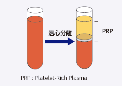 自己血液からPRPを遠心分離する。