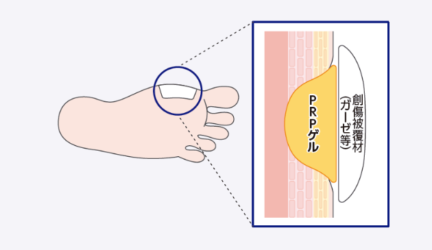 PRPゲルを創傷部位に塗布し、創傷被覆材でドレッシングをする。