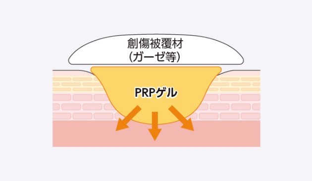 PRPゲルに含まれる成長因子が創傷に供給され、創傷治癒を促進させる。